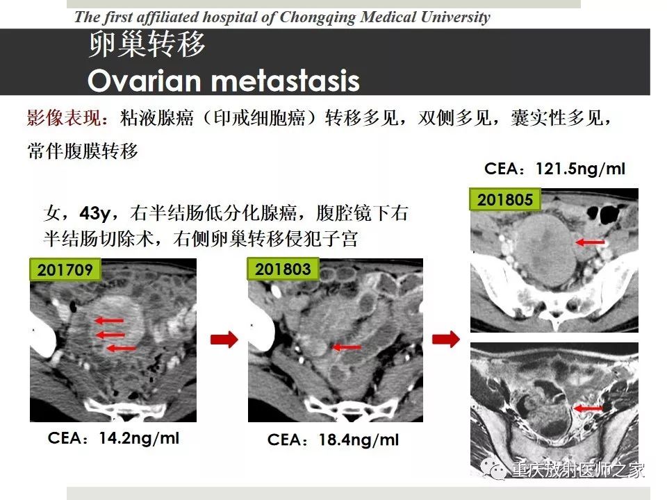 【PPT】胃肠道肿瘤术后影像报告
