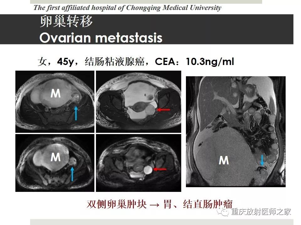 【PPT】胃肠道肿瘤术后影像报告
