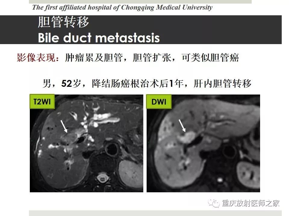 【PPT】胃肠道肿瘤术后影像报告