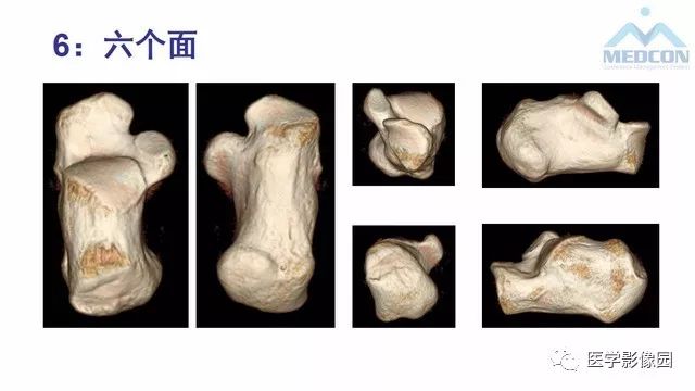 【PPT】跟骨肿瘤及肿瘤样病变影像诊断及鉴别诊断