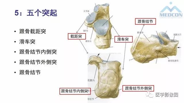 【PPT】跟骨肿瘤及肿瘤样病变影像诊断及鉴别诊断