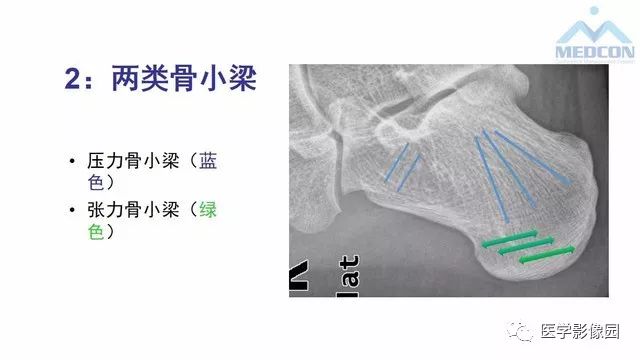 【PPT】跟骨肿瘤及肿瘤样病变影像诊断及鉴别诊断