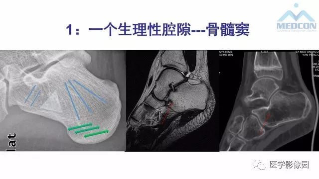 【PPT】跟骨肿瘤及肿瘤样病变影像诊断及鉴别诊断