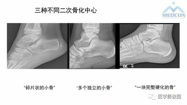 【PPT】跟骨肿瘤及肿瘤样病变影像诊断及鉴别诊断