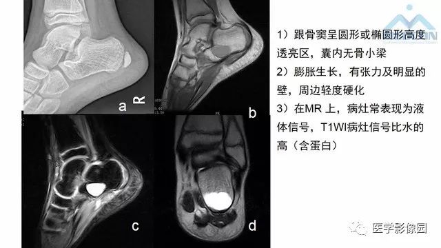 【PPT】跟骨肿瘤及肿瘤样病变影像诊断及鉴别诊断