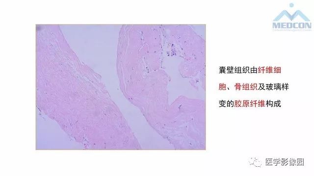 【PPT】跟骨肿瘤及肿瘤样病变影像诊断及鉴别诊断