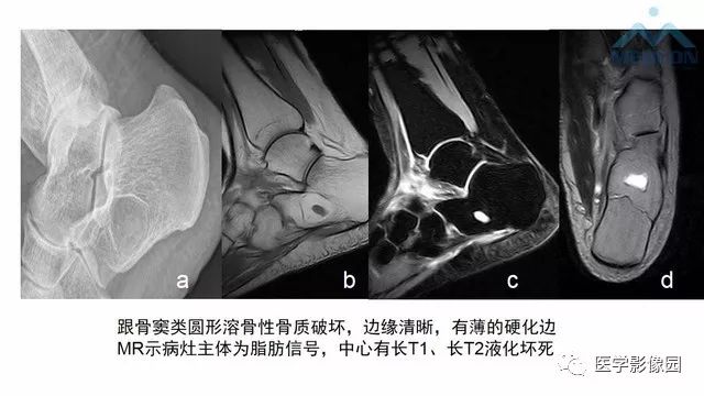 【PPT】跟骨肿瘤及肿瘤样病变影像诊断及鉴别诊断