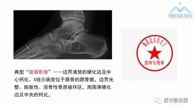 【PPT】跟骨肿瘤及肿瘤样病变影像诊断及鉴别诊断
