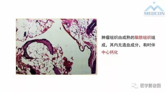 【PPT】跟骨肿瘤及肿瘤样病变影像诊断及鉴别诊断