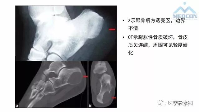 【PPT】跟骨肿瘤及肿瘤样病变影像诊断及鉴别诊断