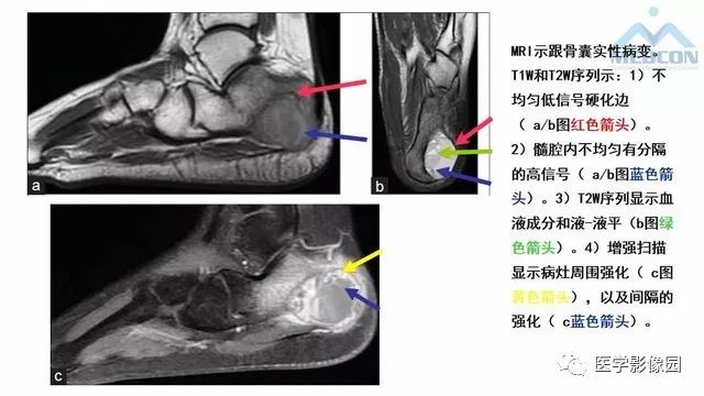 【PPT】跟骨肿瘤及肿瘤样病变影像诊断及鉴别诊断