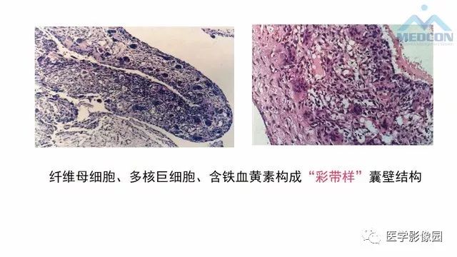 【PPT】跟骨肿瘤及肿瘤样病变影像诊断及鉴别诊断