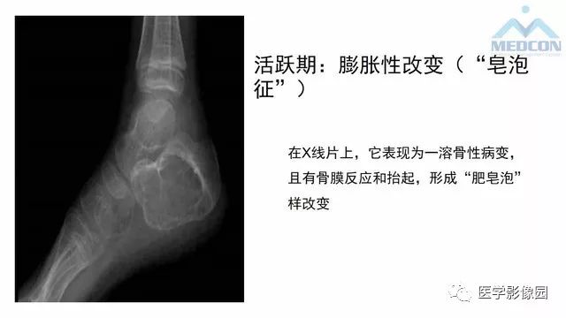 【PPT】跟骨肿瘤及肿瘤样病变影像诊断及鉴别诊断