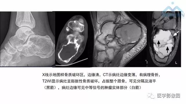 【PPT】跟骨肿瘤及肿瘤样病变影像诊断及鉴别诊断