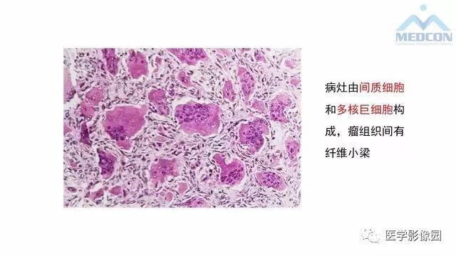 【PPT】跟骨肿瘤及肿瘤样病变影像诊断及鉴别诊断