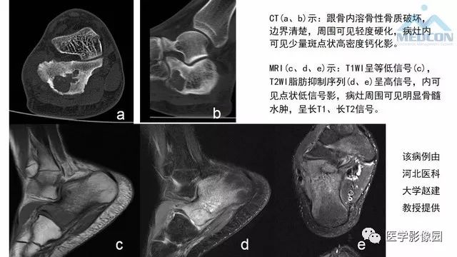 【PPT】跟骨肿瘤及肿瘤样病变影像诊断及鉴别诊断