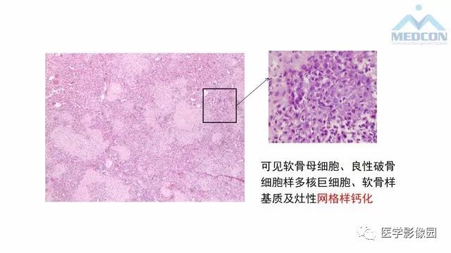 【PPT】跟骨肿瘤及肿瘤样病变影像诊断及鉴别诊断