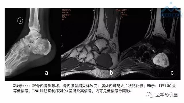 【PPT】跟骨肿瘤及肿瘤样病变影像诊断及鉴别诊断