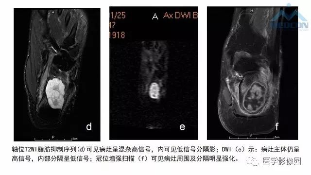 【PPT】跟骨肿瘤及肿瘤样病变影像诊断及鉴别诊断