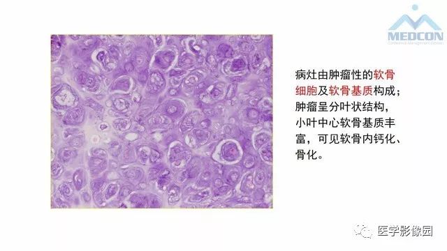 【PPT】跟骨肿瘤及肿瘤样病变影像诊断及鉴别诊断