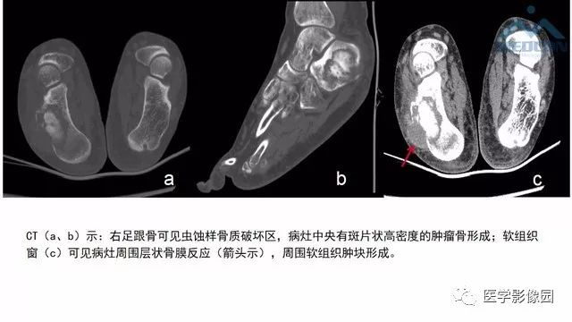 【PPT】跟骨肿瘤及肿瘤样病变影像诊断及鉴别诊断