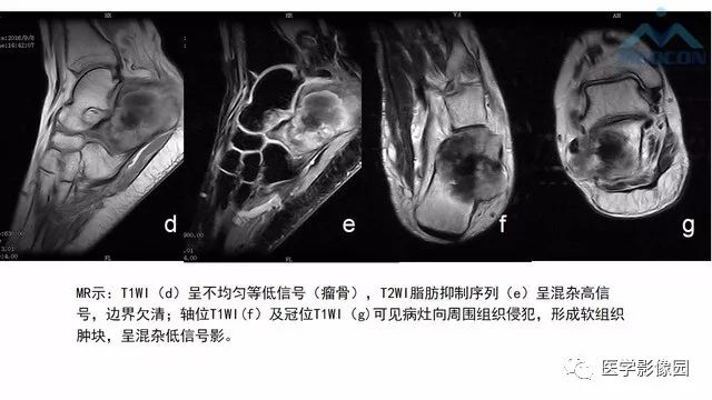 【PPT】跟骨肿瘤及肿瘤样病变影像诊断及鉴别诊断