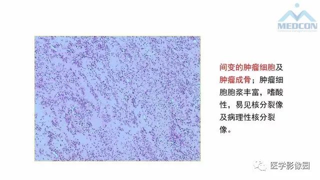 【PPT】跟骨肿瘤及肿瘤样病变影像诊断及鉴别诊断