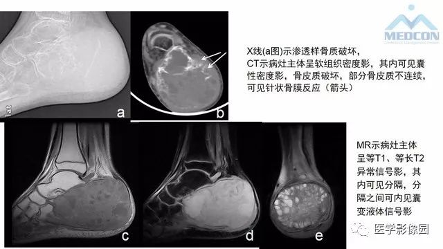 【PPT】跟骨肿瘤及肿瘤样病变影像诊断及鉴别诊断