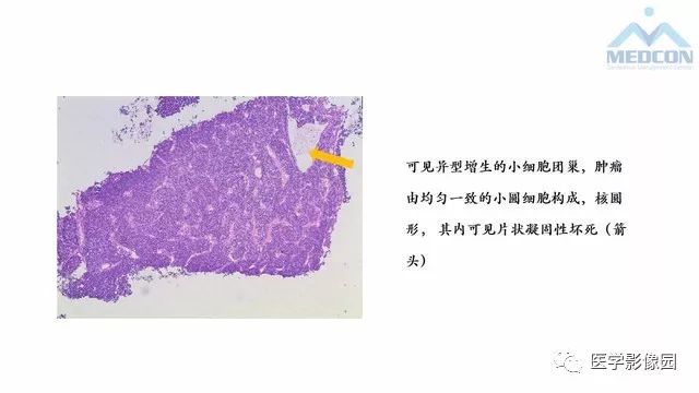 【PPT】跟骨肿瘤及肿瘤样病变影像诊断及鉴别诊断