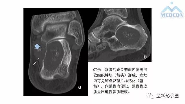 【PPT】跟骨肿瘤及肿瘤样病变影像诊断及鉴别诊断
