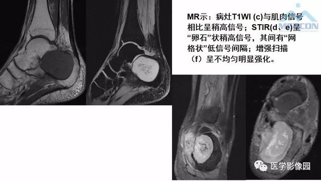 【PPT】跟骨肿瘤及肿瘤样病变影像诊断及鉴别诊断
