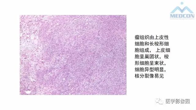 【PPT】跟骨肿瘤及肿瘤样病变影像诊断及鉴别诊断