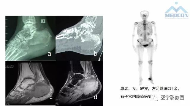 【PPT】跟骨肿瘤及肿瘤样病变影像诊断及鉴别诊断
