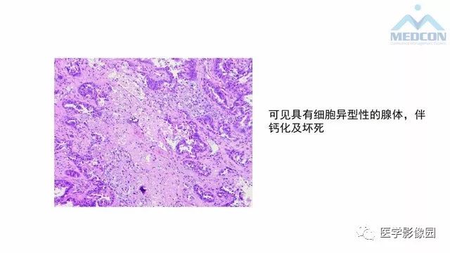 【PPT】跟骨肿瘤及肿瘤样病变影像诊断及鉴别诊断