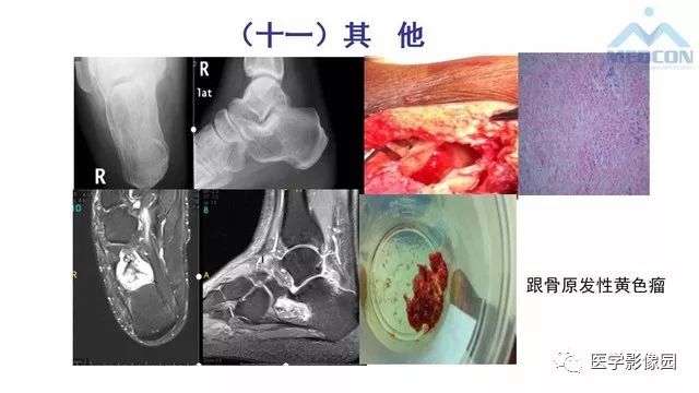 【PPT】跟骨肿瘤及肿瘤样病变影像诊断及鉴别诊断