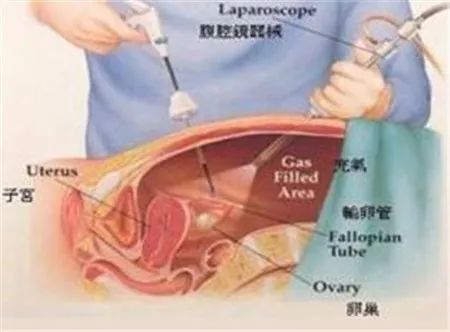 子宫输卵管造影一文搞定 子宫输卵管造影一文搞定