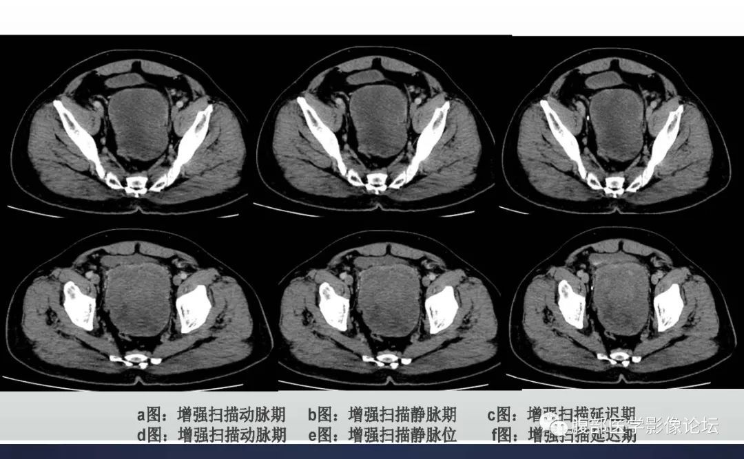【病例】盆腔孤立性纤维性肿瘤1例CT及MR影像