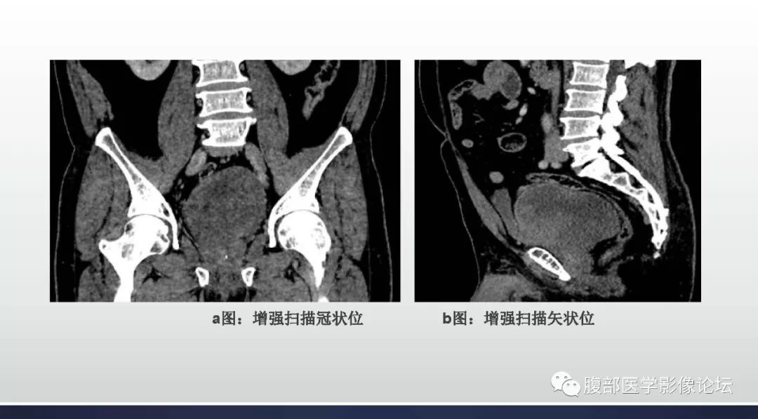 【病例】盆腔孤立性纤维性肿瘤1例CT及MR影像