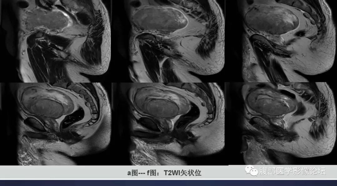 【病例】盆腔孤立性纤维性肿瘤1例CT及MR影像