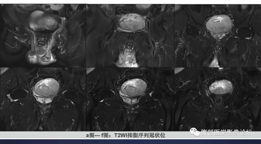 【病例】盆腔孤立性纤维性肿瘤1例CT及MR影像