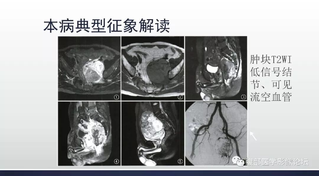 【病例】盆腔孤立性纤维性肿瘤1例CT及MR影像