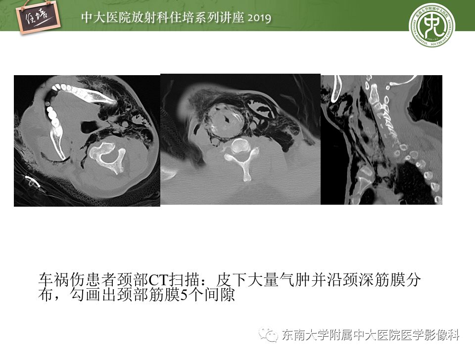 【PPT】颈部间隙的影像解剖及诊断思路