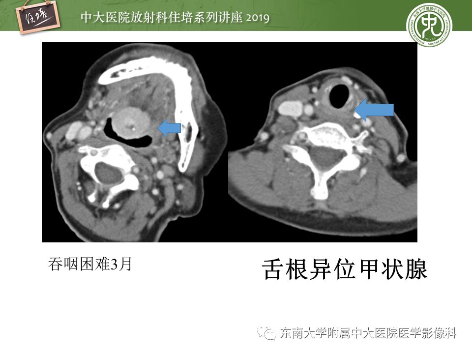 【PPT】颈部间隙的影像解剖及诊断思路