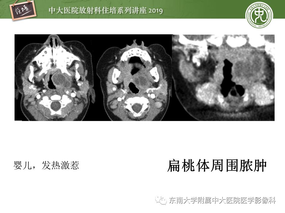 【PPT】颈部间隙的影像解剖及诊断思路