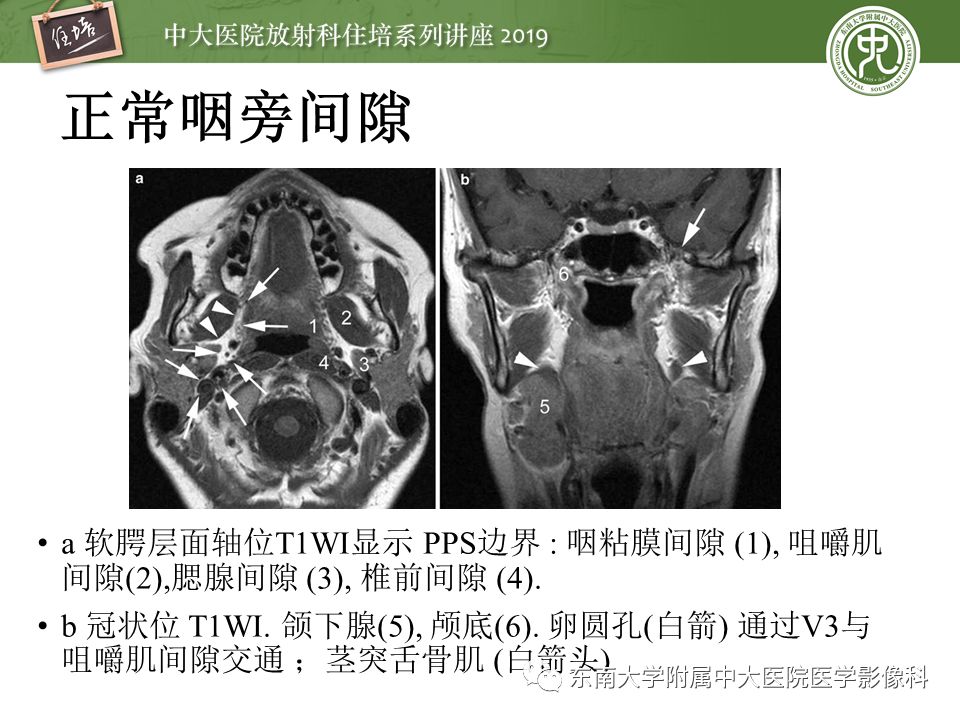 【PPT】颈部间隙的影像解剖及诊断思路