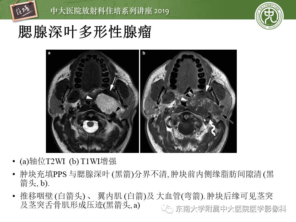 【PPT】颈部间隙的影像解剖及诊断思路