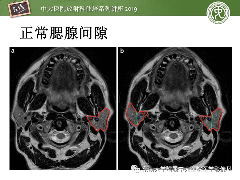 【PPT】颈部间隙的影像解剖及诊断思路