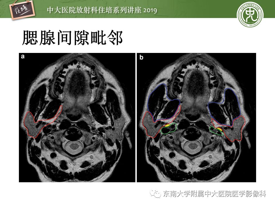 【PPT】颈部间隙的影像解剖及诊断思路