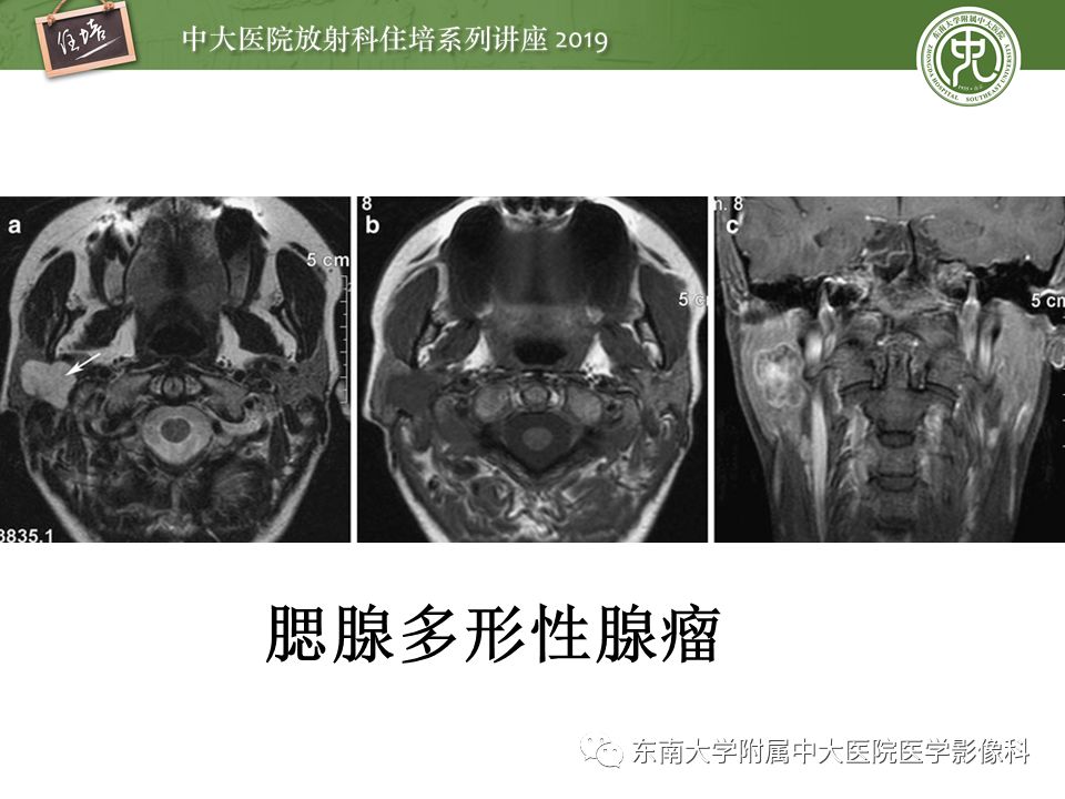 【PPT】颈部间隙的影像解剖及诊断思路