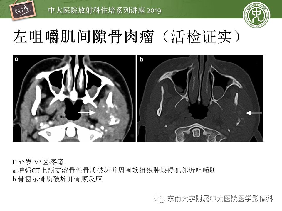 【PPT】颈部间隙的影像解剖及诊断思路